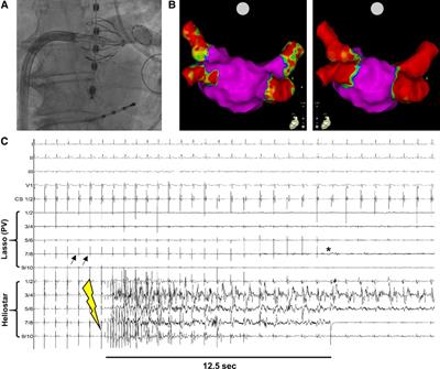 Implementation of the multielectrode radiofrequency-balloon in real-world clinical practice—operator learning curve and procedural outcome at a high-volume center